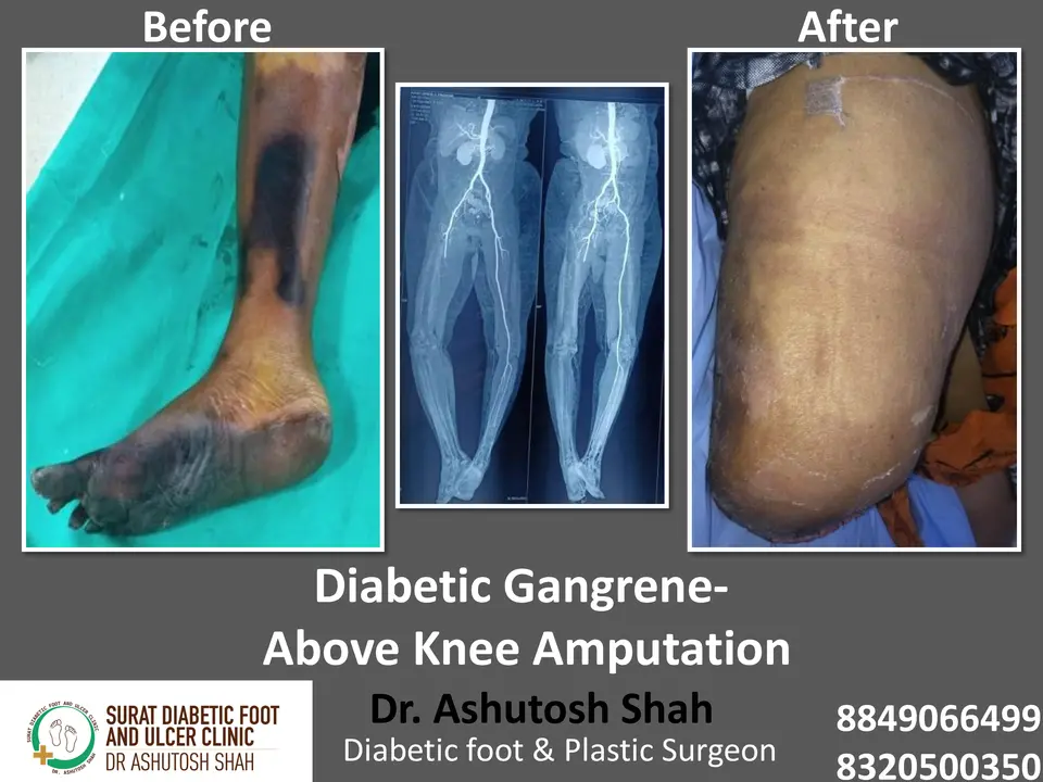 Diabetic Foot  PPT sunita.pptx-20.webp